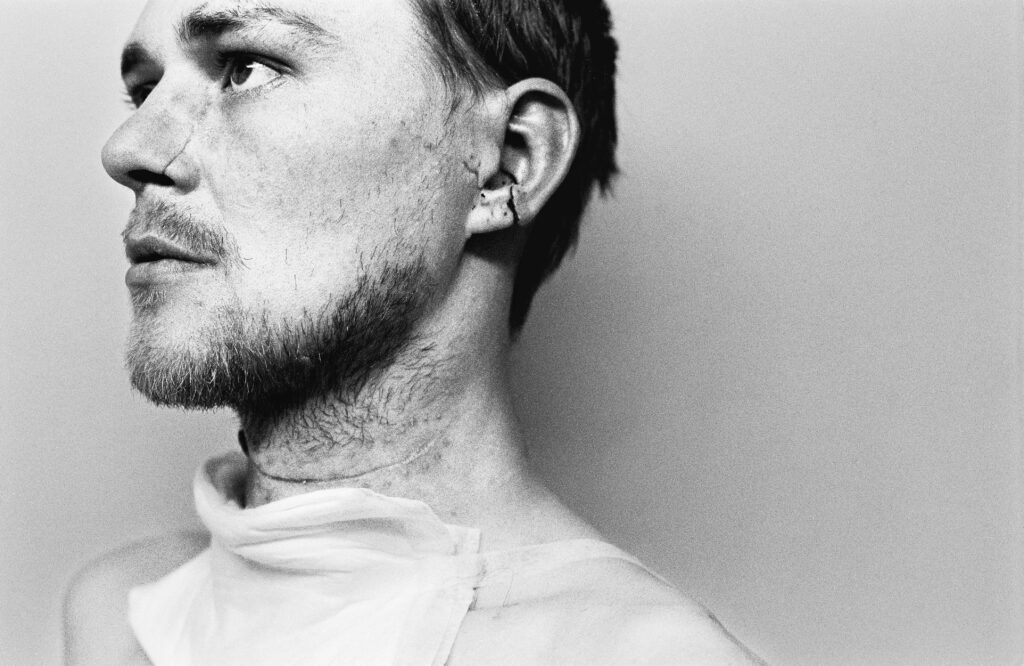 A young man shows the fresh wounds of a violent attack where he was stabbed repeatedly and had his throat cut for drug debts in Glasgow, Scotland